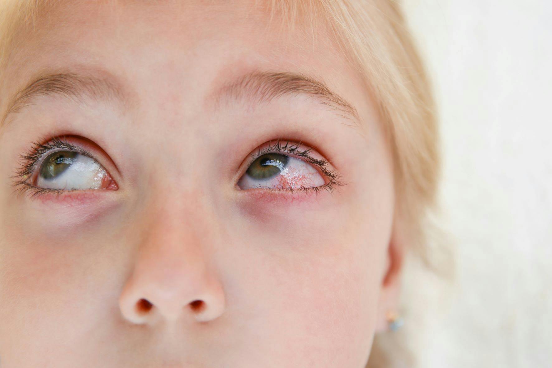 Trẻ bị đau mắt đỏ nên làm gì? Nguyên nhân, triệu chứng và cách điều trị